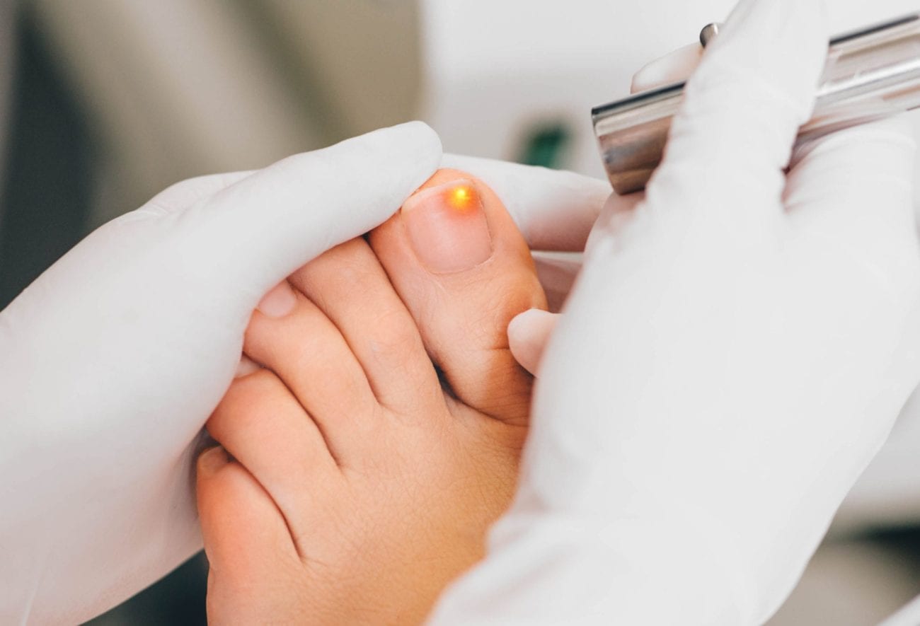 Laser Fungal Nail Treatment Newtown PA | Nail Fungus Bucks County