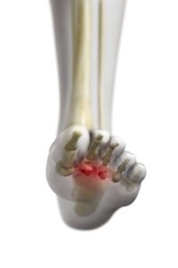 Mortons neuroma treatment in Newtown PA Bucks County