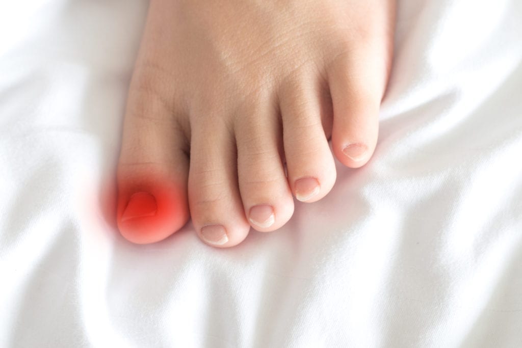 Ingrown nail or onychocryptosis treatment in Newtown PA