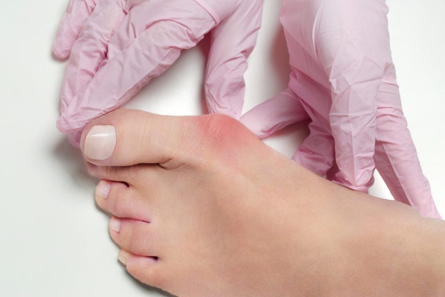 Treatment Options for Bunions Foot & Ankle Specialists