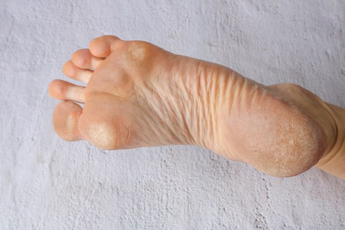 Plantar callus removal: how to get rid of calluses on feet