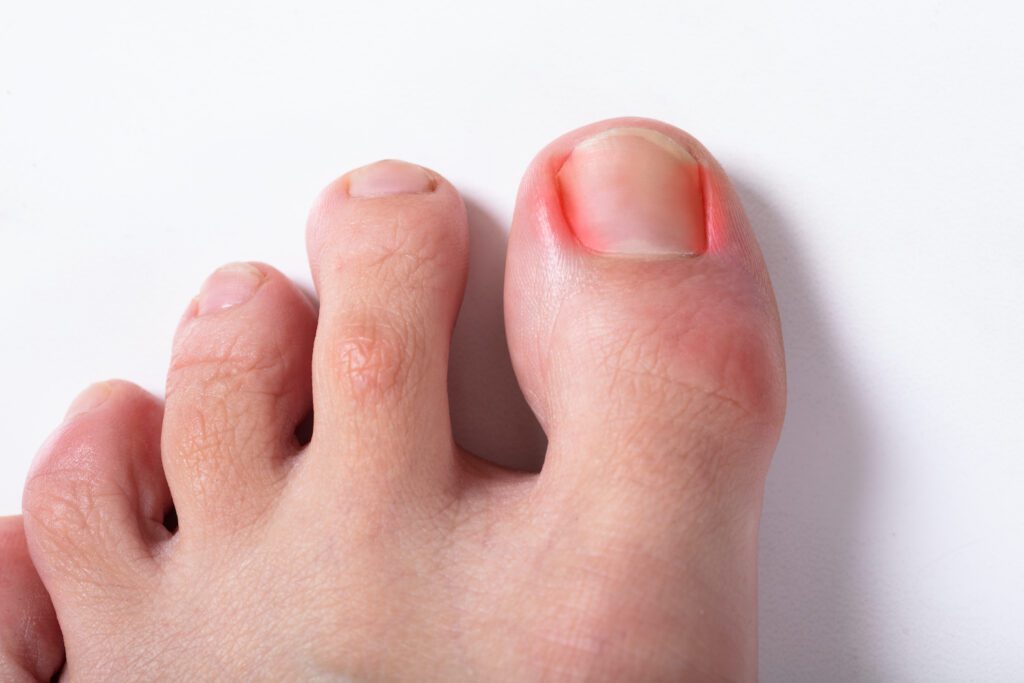 There are several effective strategies to help prevent ingrown toenails and maintain healthy feet and nails.